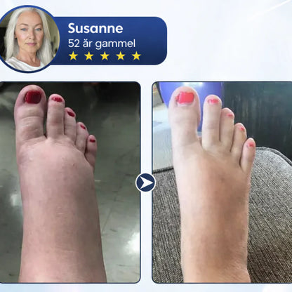 Sveora™ – Lindrande benkräm för lättare ben och bättre blodcirkulation 1+1 Gratis
